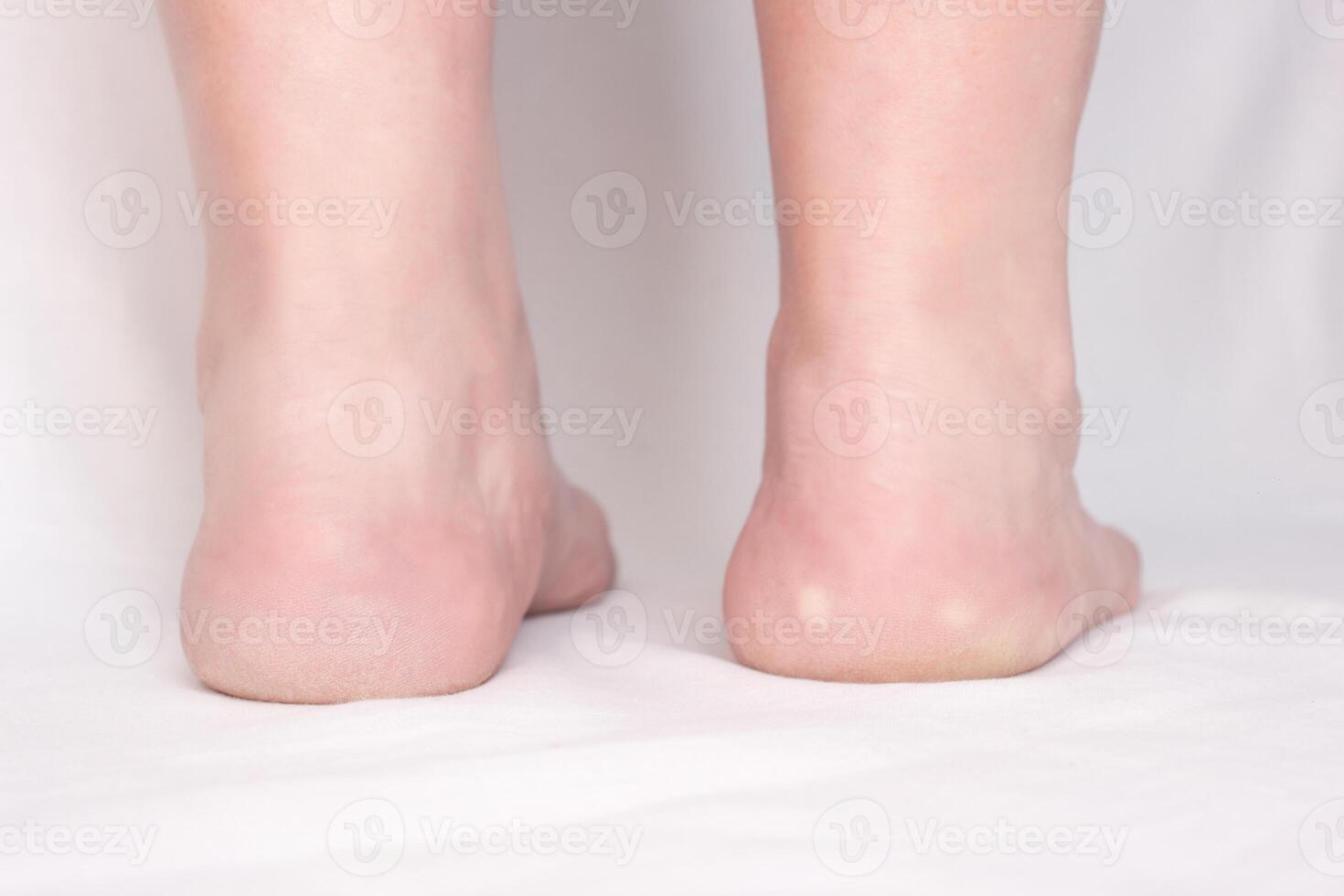 Female feet with spots on a white background with heel spur disease, close-up, plantar fasciitis photo