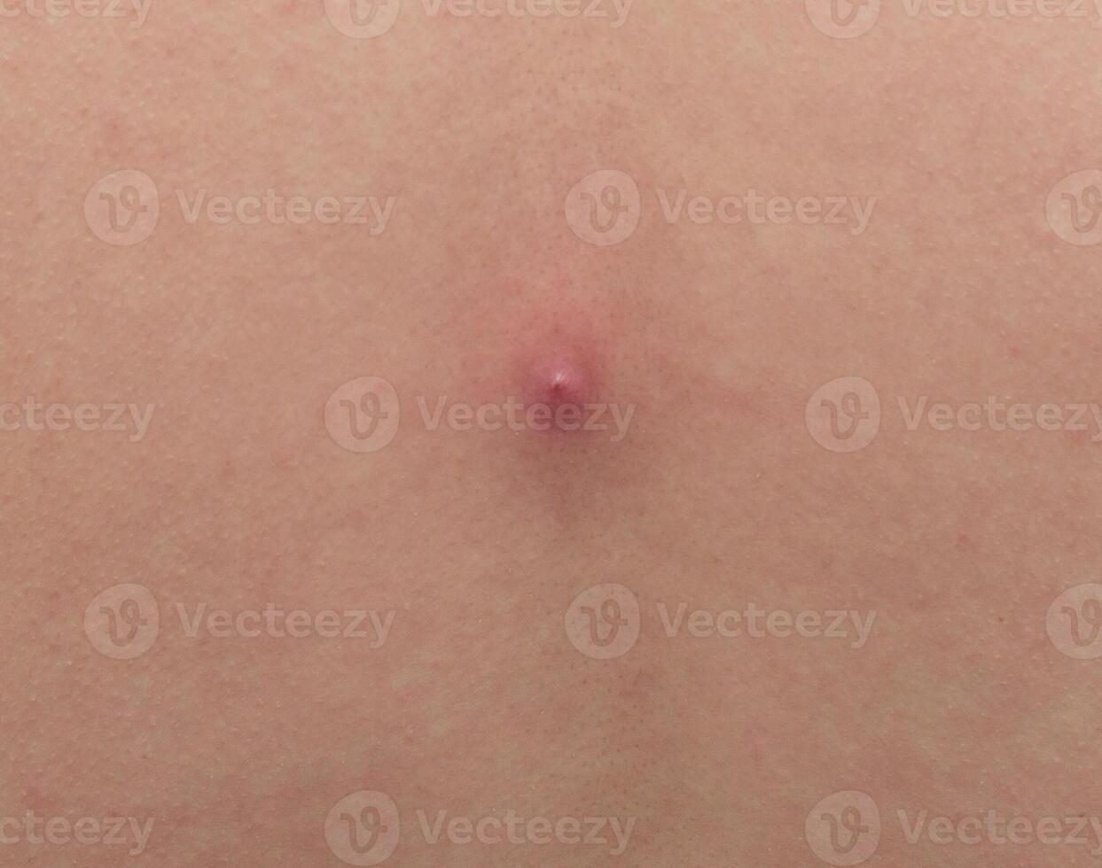Big red pimple abscess on the skin, close-up, pimple inflammation on the skin, copy space, infection photo
