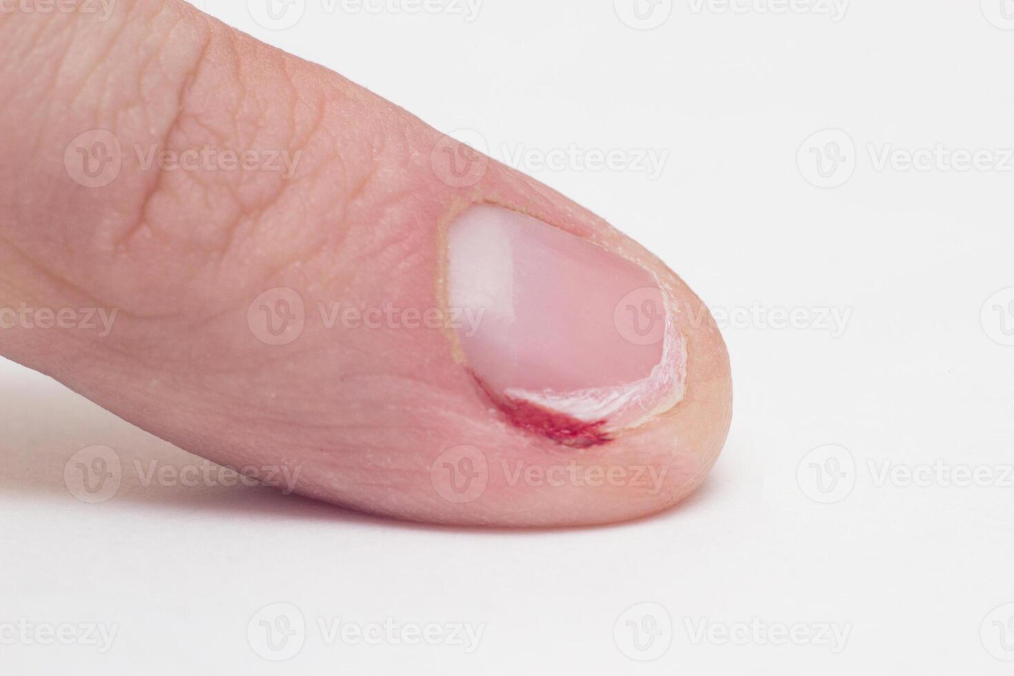 Finger with gnawed nail and cuticle with blood, macro, white background, habit, medical photo