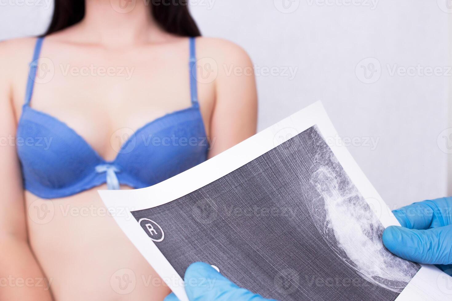 Doctor holding a mammography scan to a girl patient with breast disease mastopathy, close-up photo