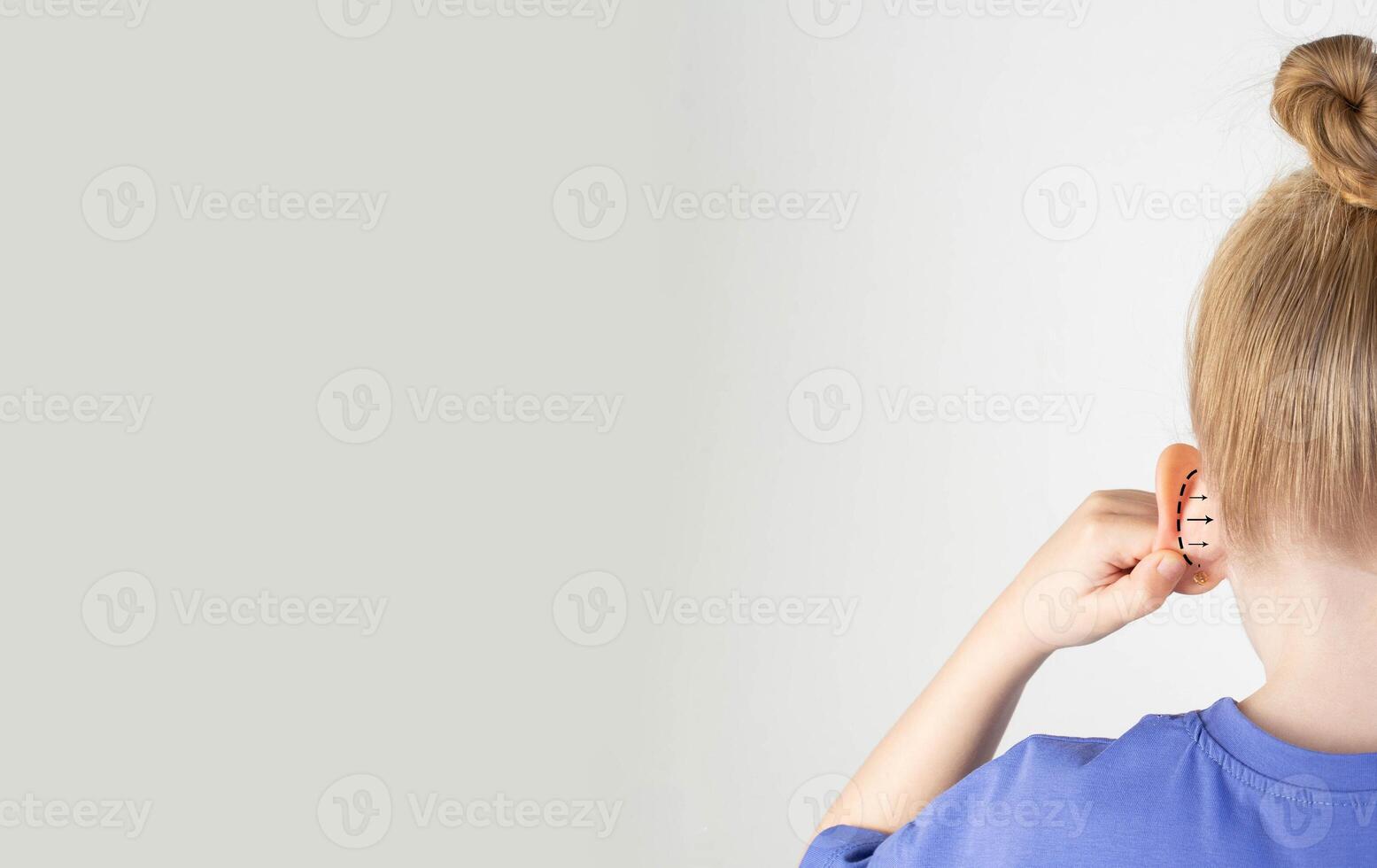 The girl holds her hand on her protruding protruding ear with marks for plastic surgery. Changes in the shape of the pinna and ear. Pediatric otoplasty. Copy space for text photo