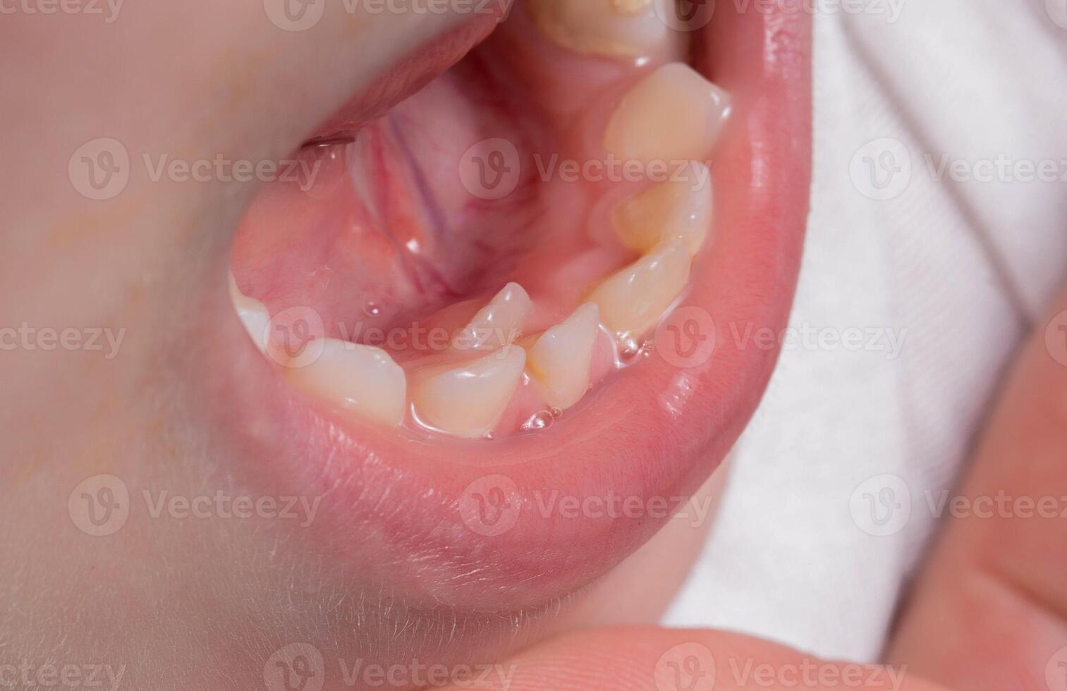 A child's tooth grows second next to the milk teeth. Formation of the jaw and permanent teeth in children. Removal of milk teeth, close-up photo