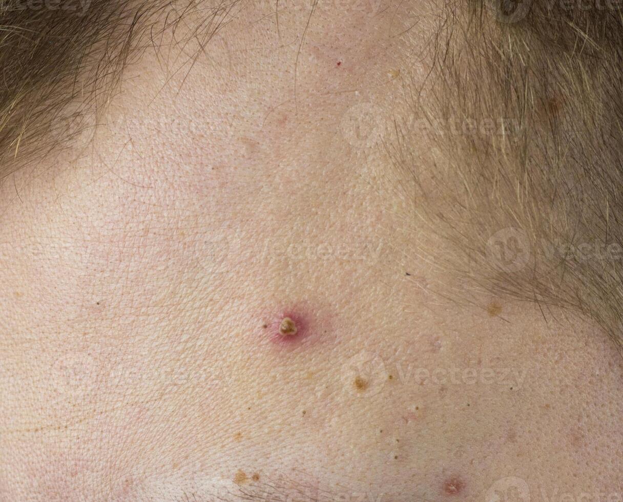 Big red pimple on the man's forehead, close-up, problem skin, white-head photo