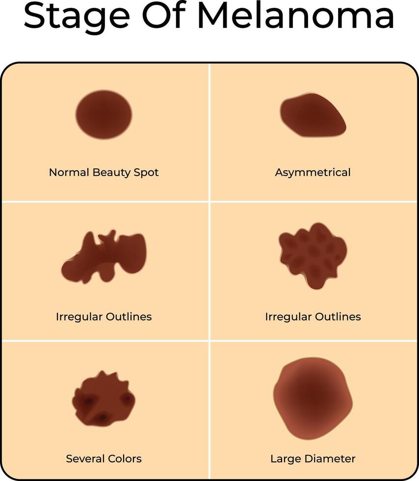 Stage of Melanoma Science Design Illustration Diagram vector