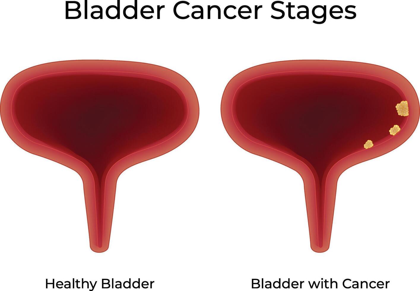 Bladder Cancer Stages Science Design Illustration Diagram vector