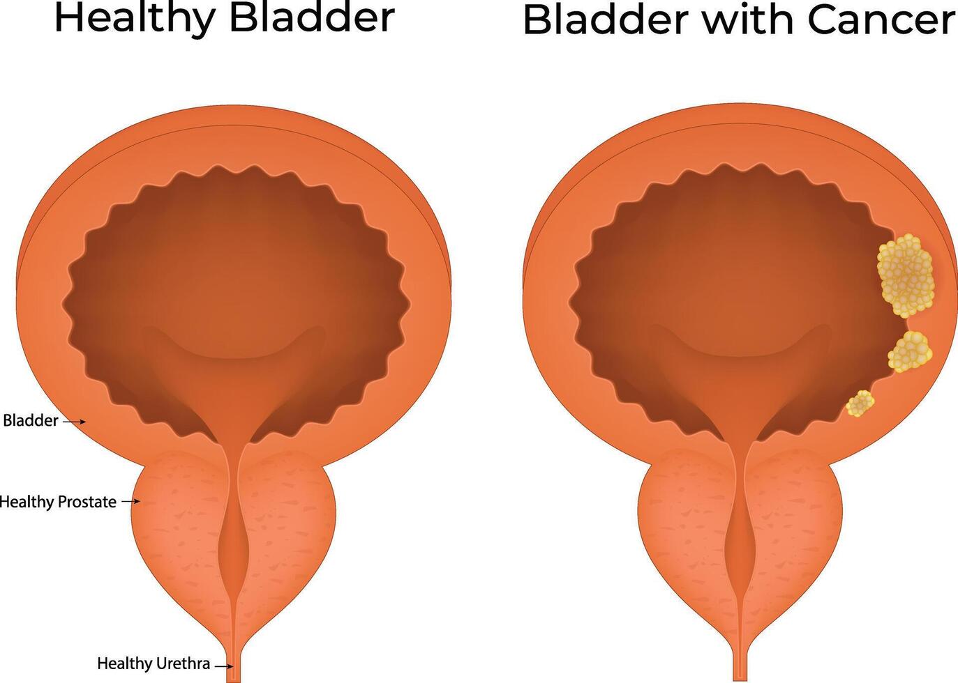 Healthy Bladder and Cancer Bladder Science Design Illustration Diagram vector