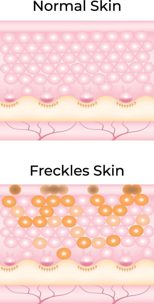Normal Skin Freckles Skin Science Design Illustration Diagram vector