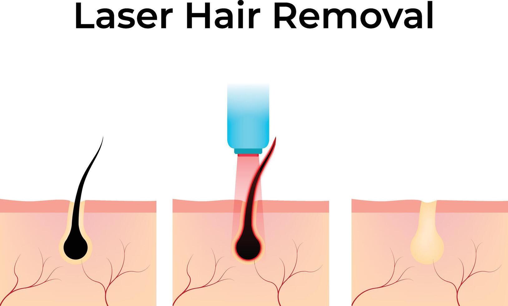 Laser Hair Removal Design Illustration vector