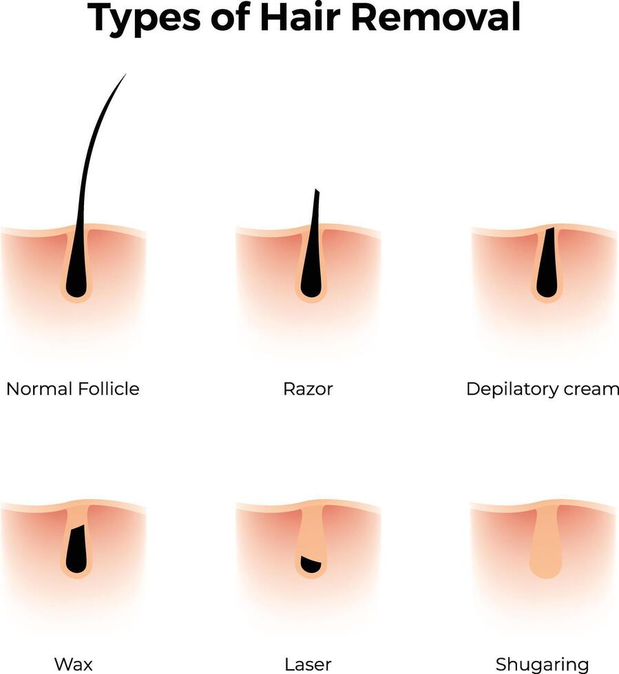 Types of Hair Removal Design Illustration vector