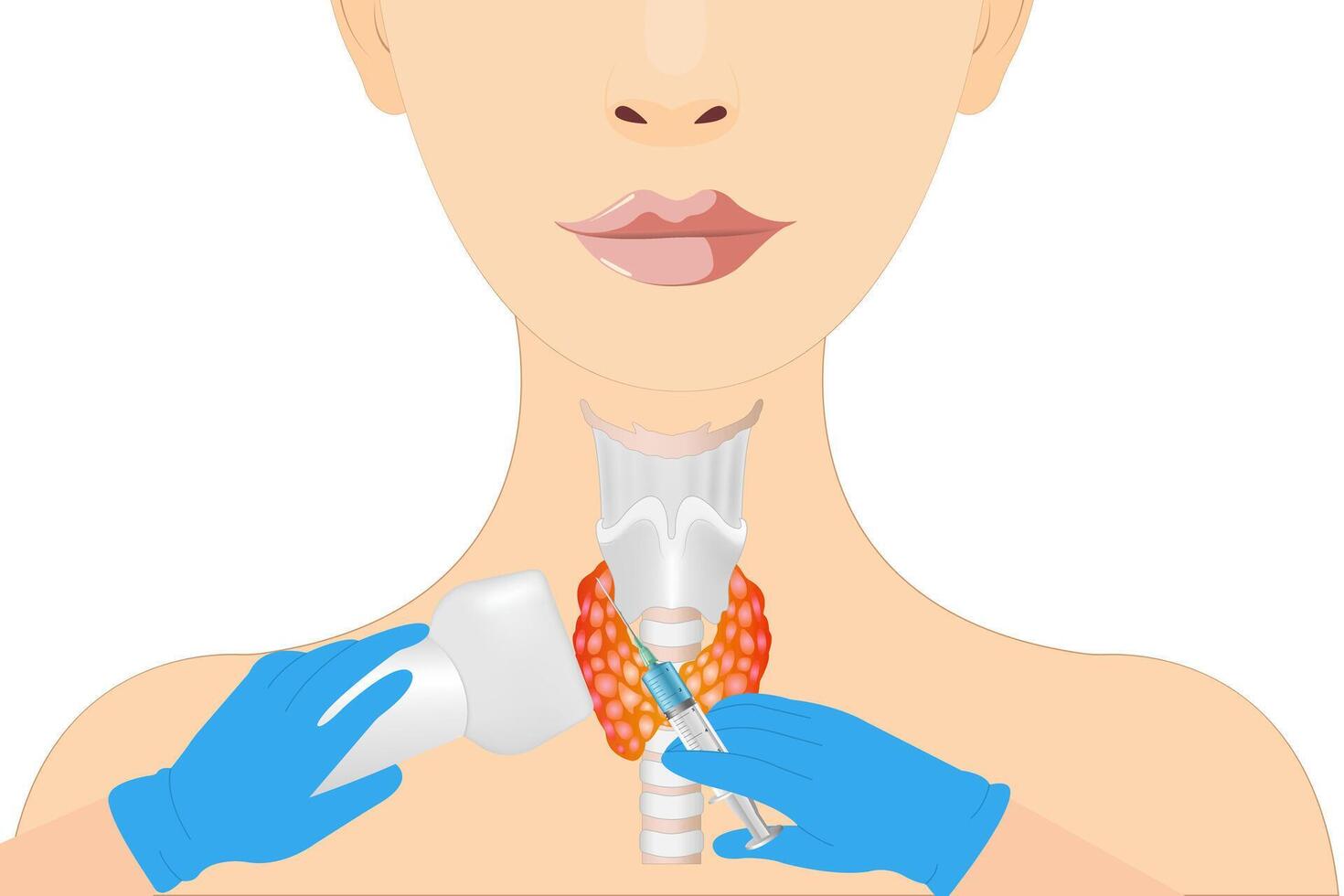 Thyroid cancer disease, nodules, ultrasound screening, medical treatment, fine needle aspiration, lumps, test lab, gland, neck pain vector