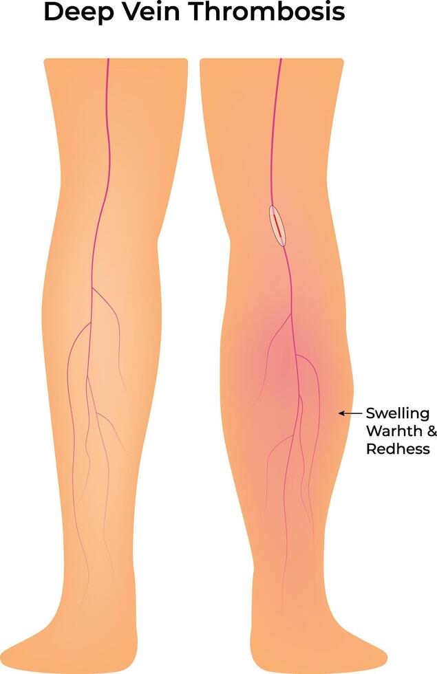 Deep Vein Thrombosis Science Design Illustration Diagram vector