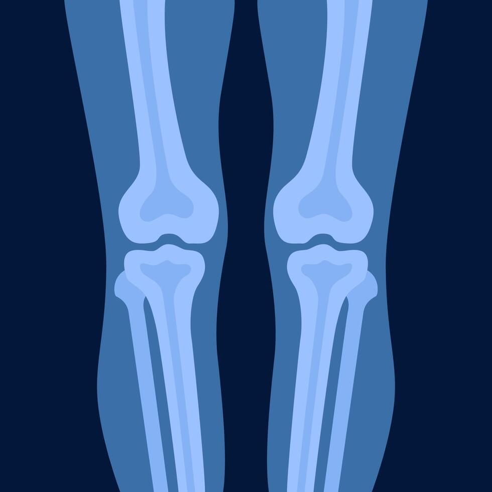 Xray of human knees bones and joints, examination and diagnosis. Healthcare and rheumatism analysis, physical care in hospital or clinics. illustration. vector