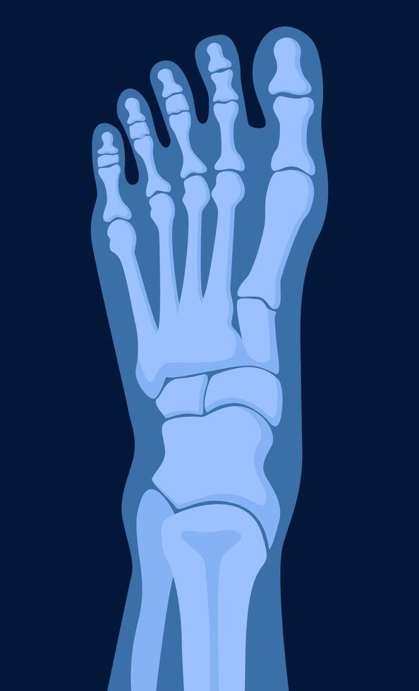 X ray human foot. X-ray picture or radiographic monitor image of metatarsus bones and toes. Medical radiology. illustration. vector