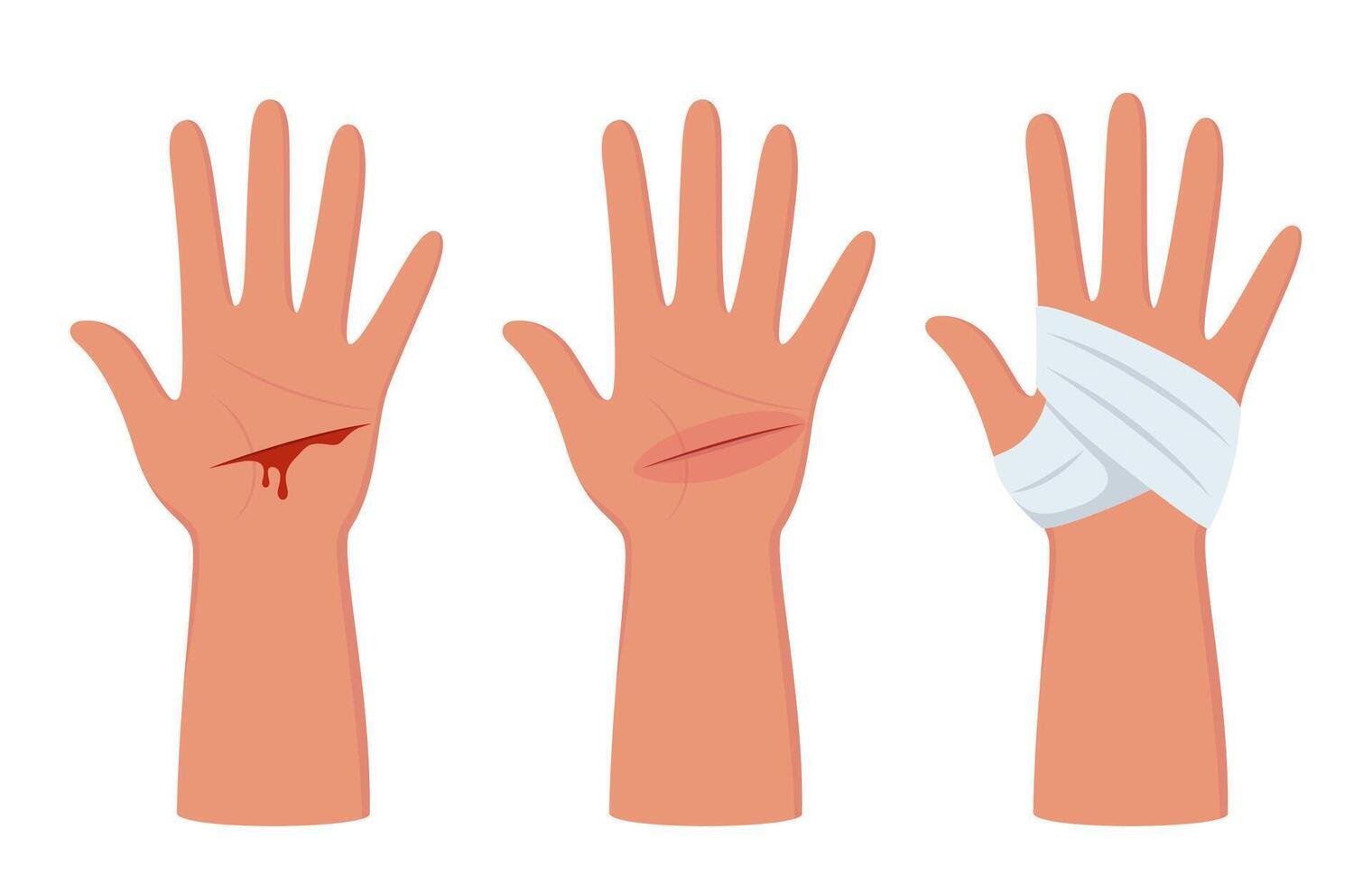Bleeding cut on the palm, emergency situation. First aid treatment for wound on skin. Trauma, treatment procedure. illustration. vector