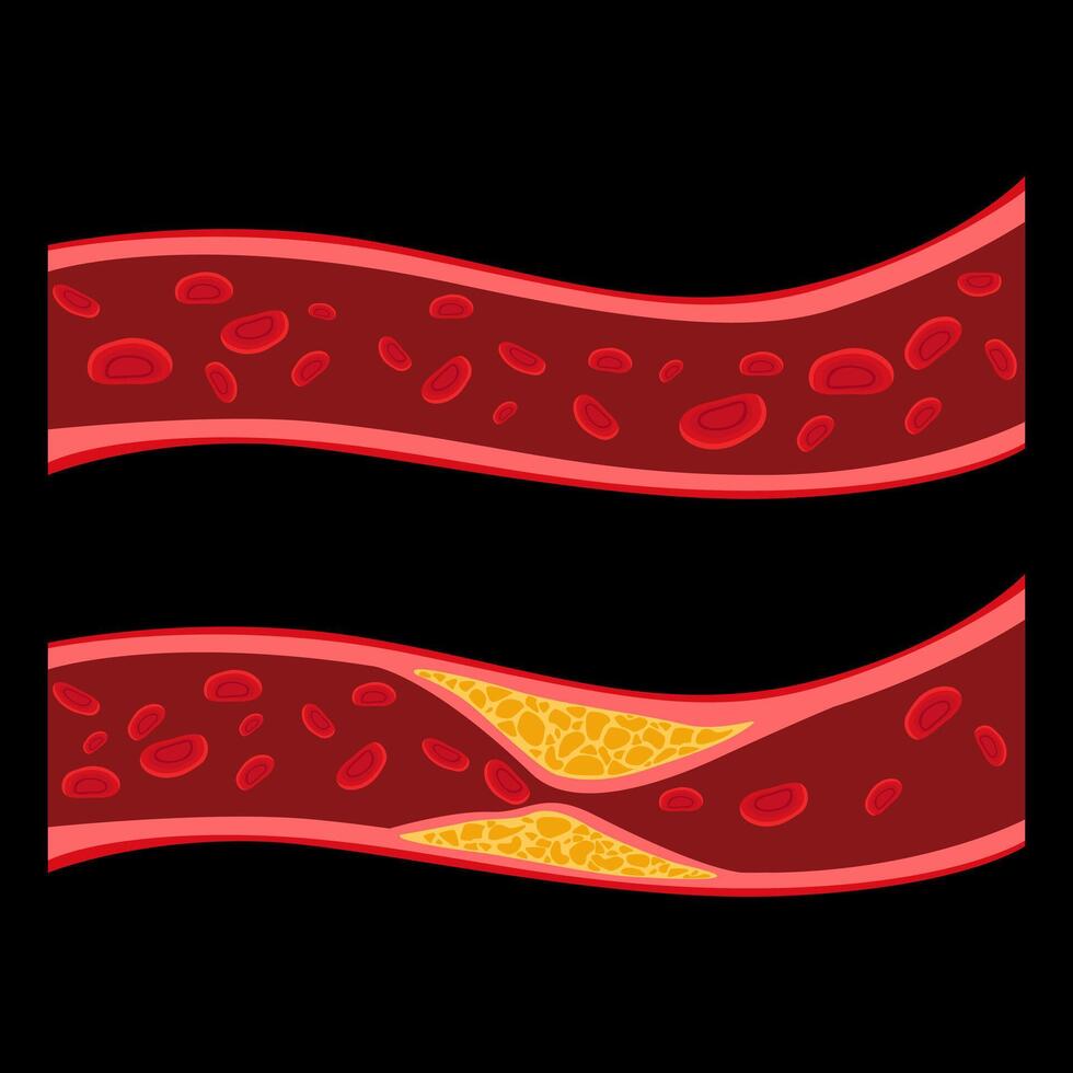 Artery blocked cholesterol plaque build blood health illustration art design vector