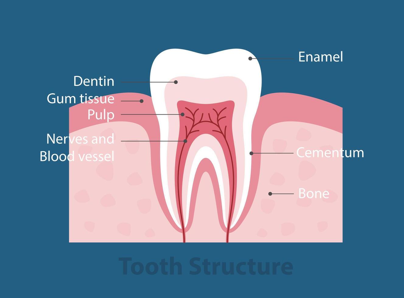 The stages of tooth decay, illustration vector