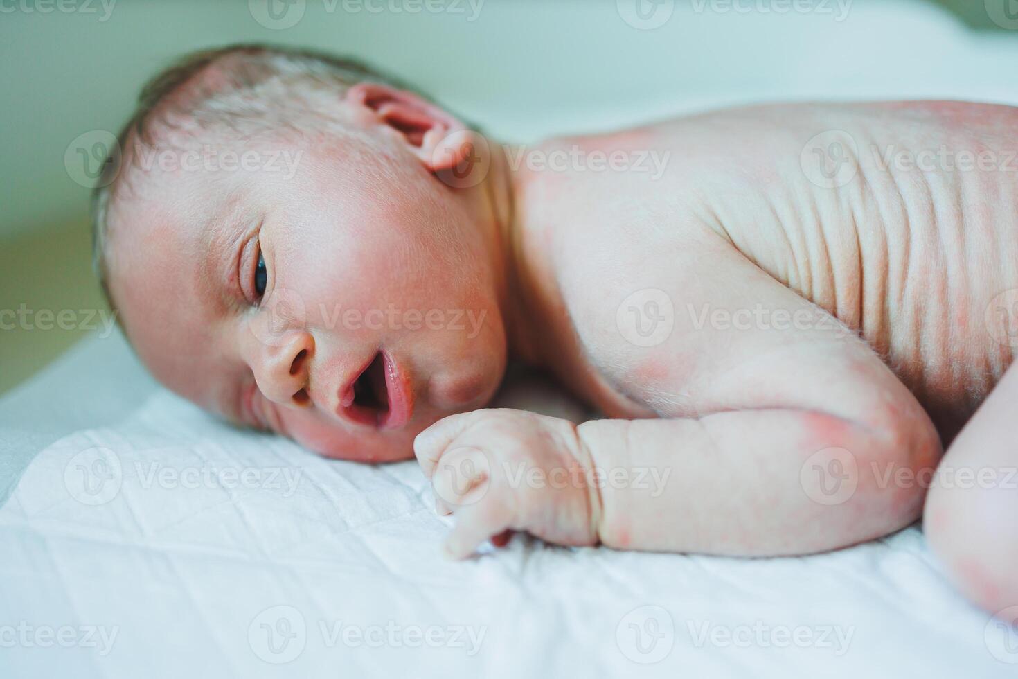 A newborn baby is lying on a diaper with a red rash on his body. Sweating of a newborn child. photo
