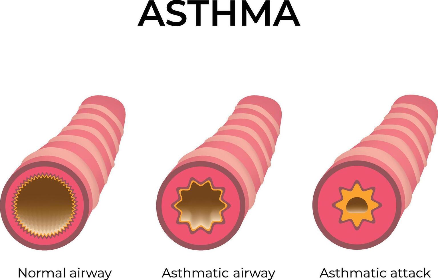 Asthma Normal Airway Asthmatic Airway Asthmatic Attack Design Illustration vector