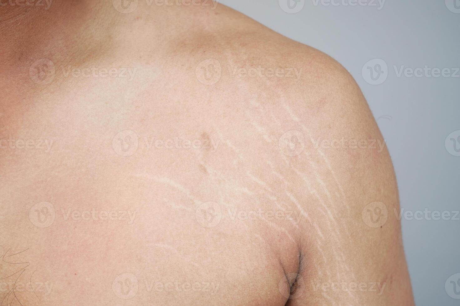 Close-Up of Stretch Marks on Human Skin for Medical and Cosmetic Purposes photo