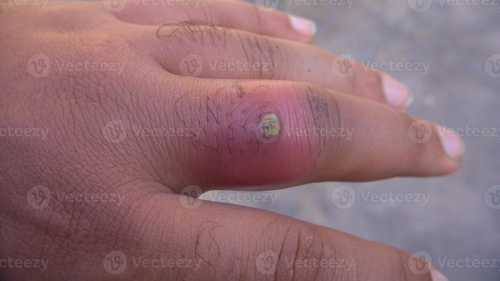 Close-up of a Red Swollen Finger with Pus-Filled Infection photo