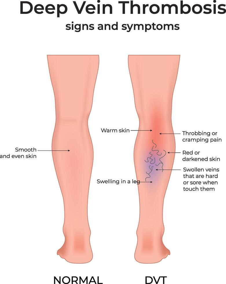 Deep Vein Thrombosis Signs and Symptoms vector