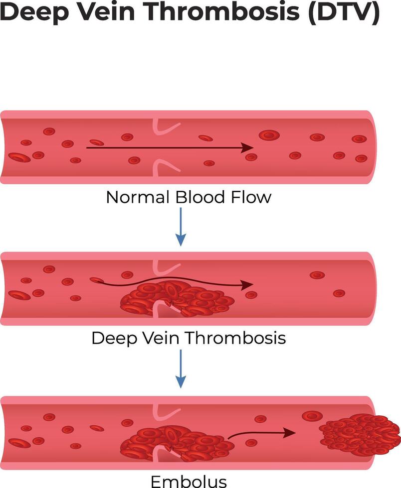 Deep Vein Thrombosis Design Illustration vector