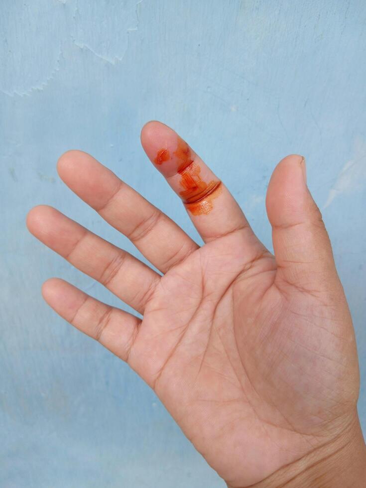 A dog bite wound and blood on hand. Infection and Rabies concept.Sarting of Rabies. photo