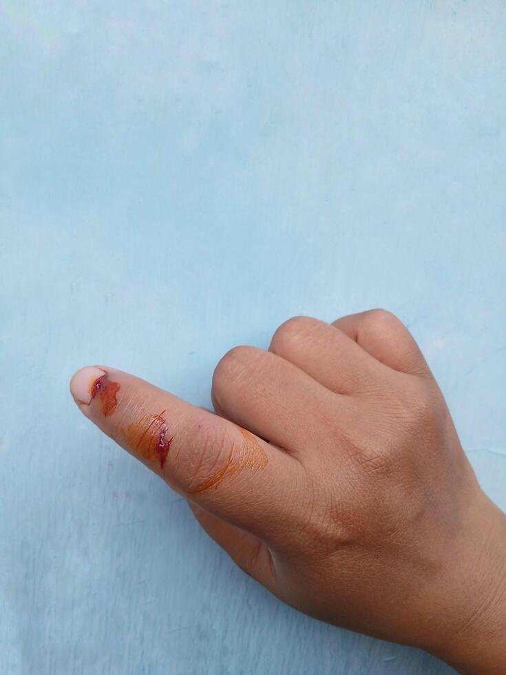 A dog bite wound and blood on hand. Infection and Rabies concept.Sarting of Rabies. photo