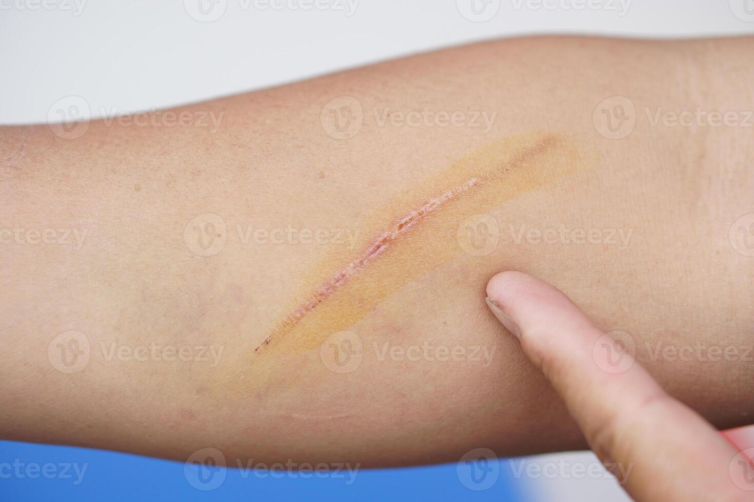 Scratch wound on arm skin. Concept, physical injury from accident. It can be scar on skin after it's dry. photo