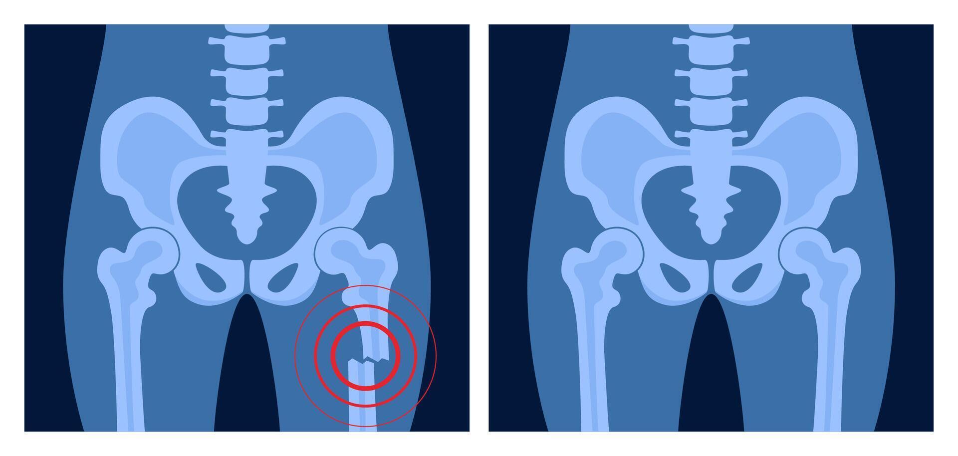 X ray of femur fracture with red pain point. Broken leg with open type of fracture. Human skeleton anatomy concept. Medical banner for clinic or hospital. illustration vector