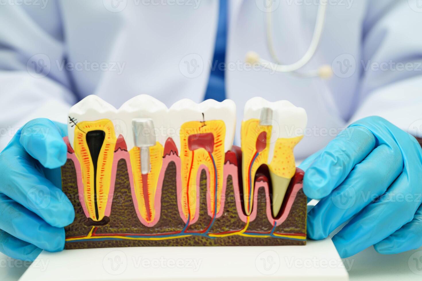 Dentist holding dental implant, artificial tooth roots into jaw, root canal of dental treatment, gum disease, teeth model for dentist. photo
