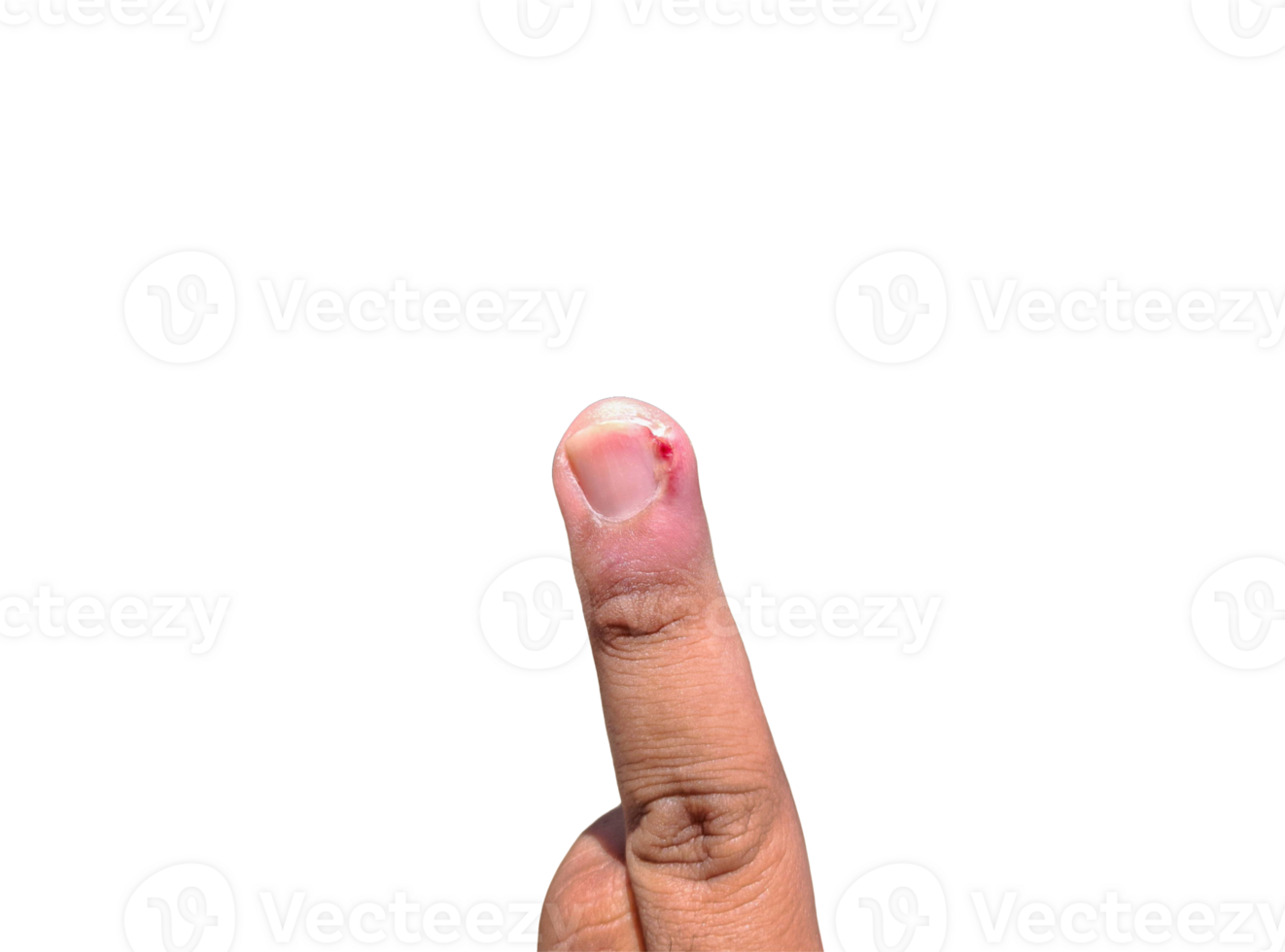 middle finger injured by an ingrown toenail png