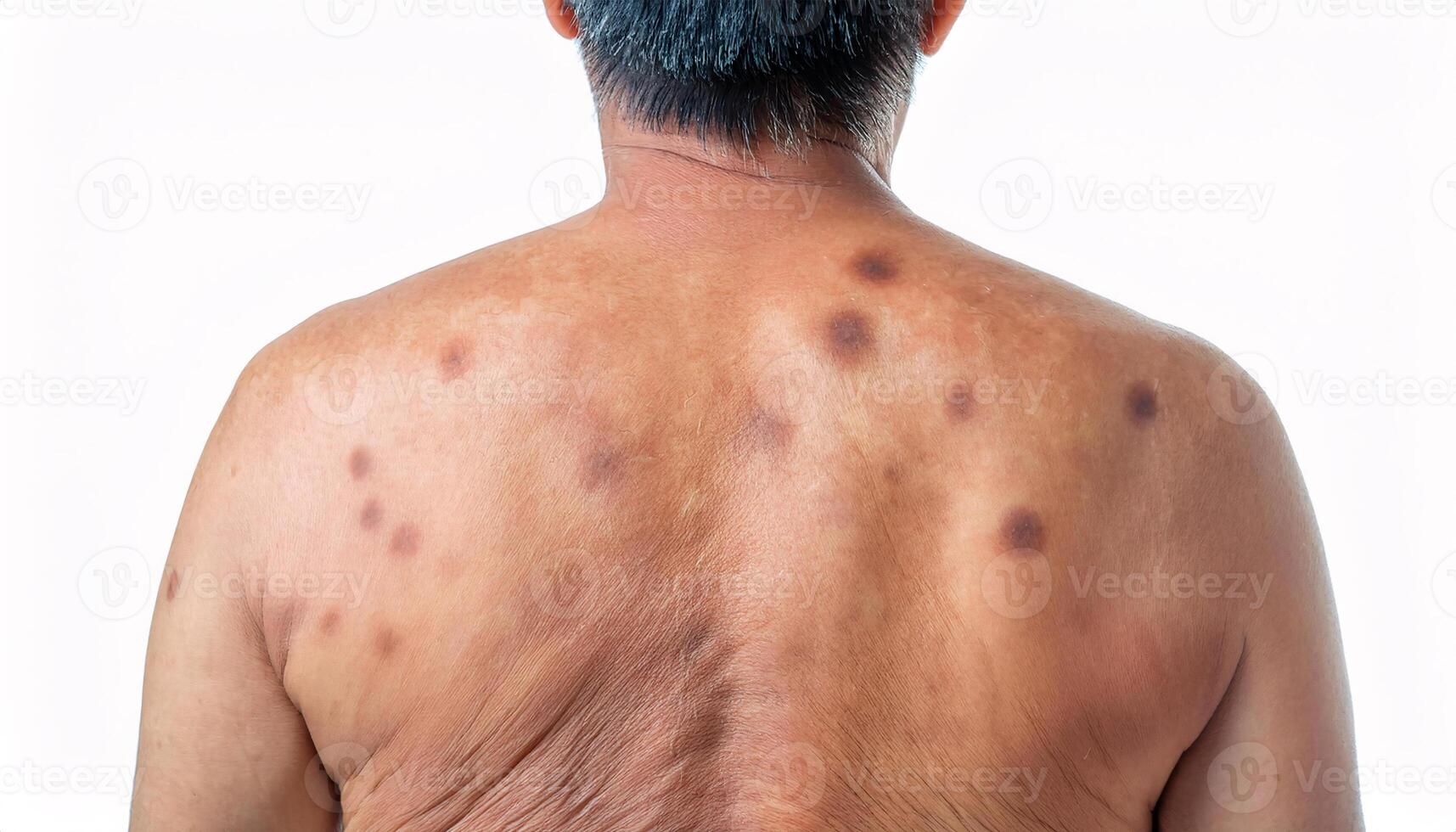 macro view of dark age spots on the upper back of an adult, showcasing uneven pigmentation and skin texture isolated on white background photo