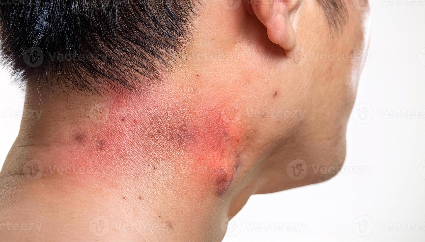 detailed shot of allergic contact dermatitis on the neck showing redness, inflammation, and irritated skin texture photo