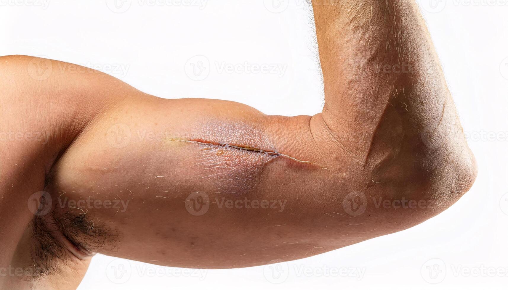 detailed view of a large scar from a cut on the flexed bicep, showing uneven healing in isolated white background photo