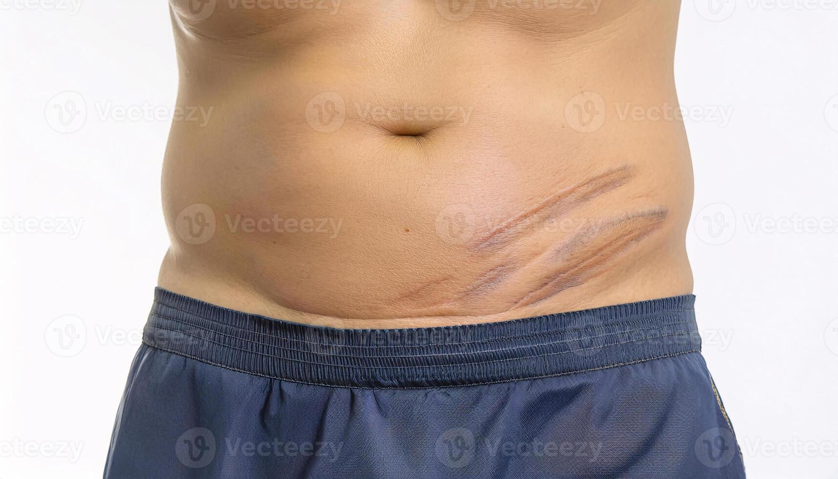 close-up of a c-section surgical scar on the lower abdomen, showing detailed healed stitch marks and skin texture in isolated white background photo