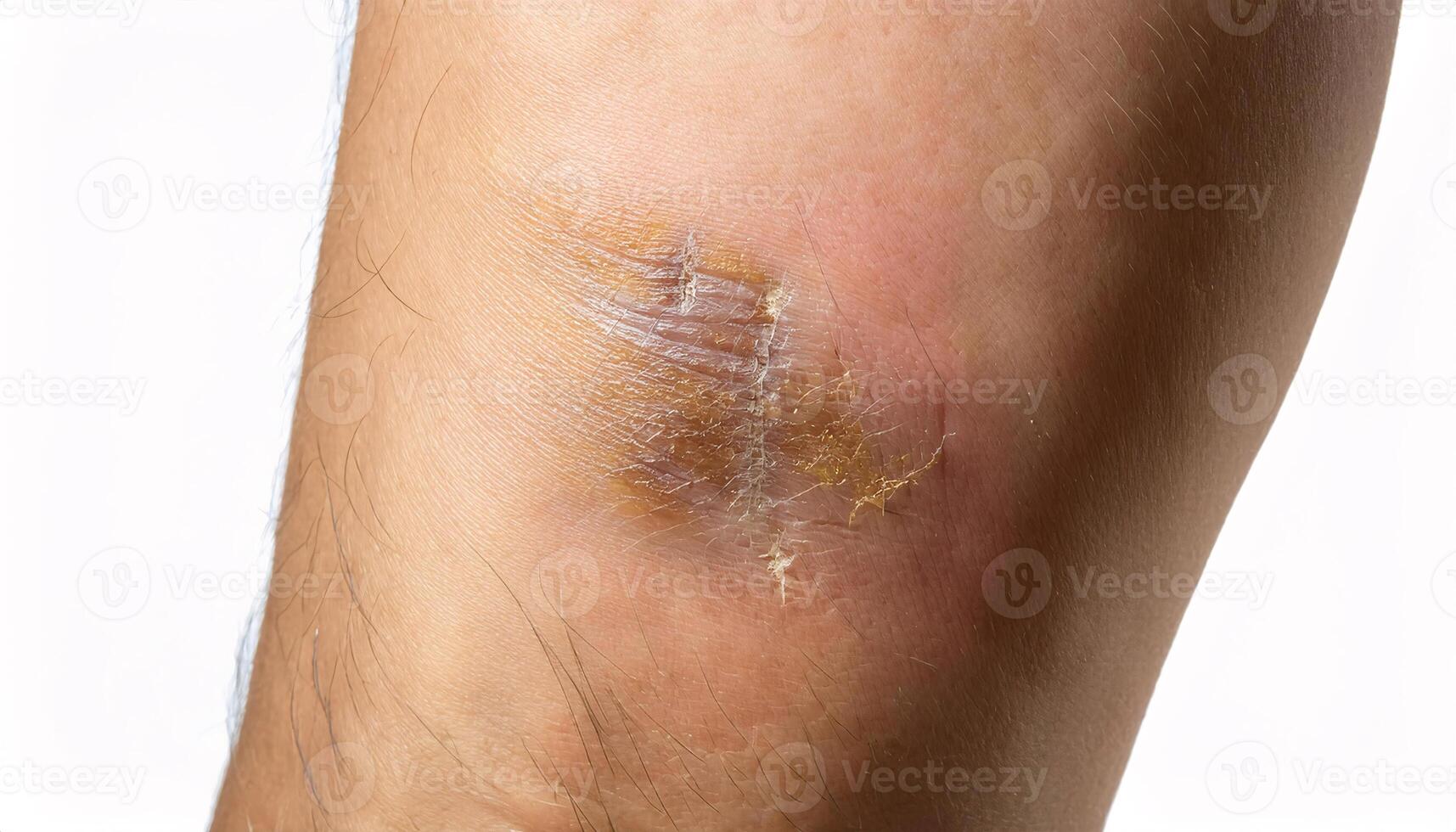 close-up of an old scar on the shin caused by a broken bottle accident with faint yet textured healing and visible skin details on isolated white background photo