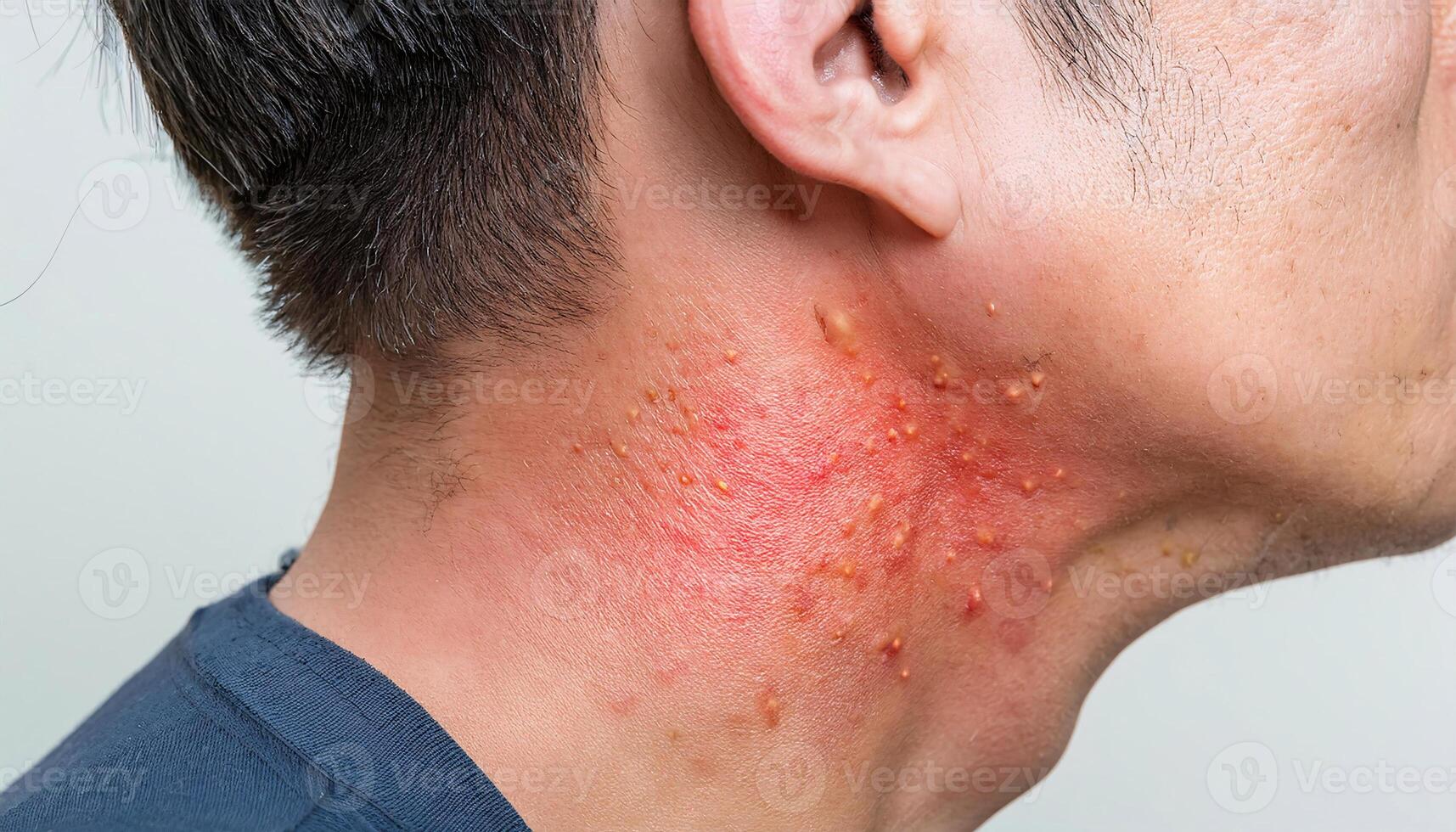 detailed shot of allergic contact dermatitis on the neck with severe redness, inflamed pustules, and skin irritation from allergic reaction photo