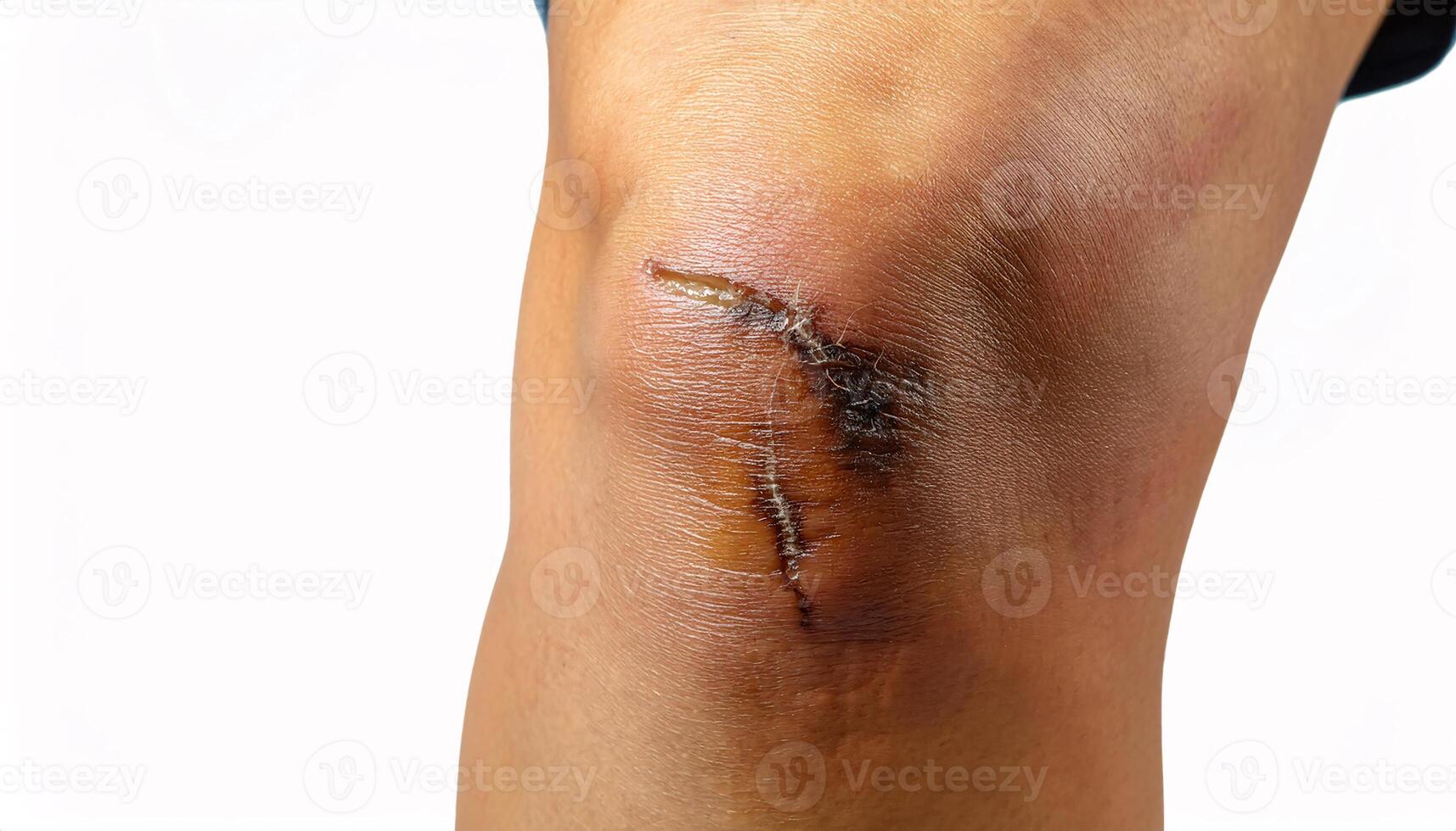 Close-up of a scar on the shin from tripping over tree roots, textured and uneven in isolated white background photo