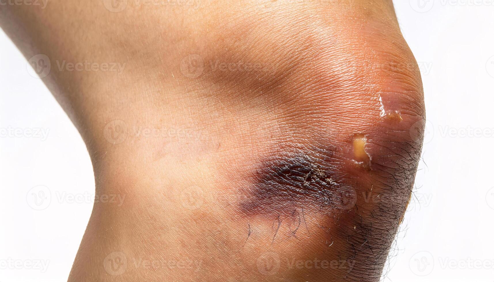 macro image of a scar from a radiator burn on the lower leg, showing discoloration and healing texture in isolated white background photo