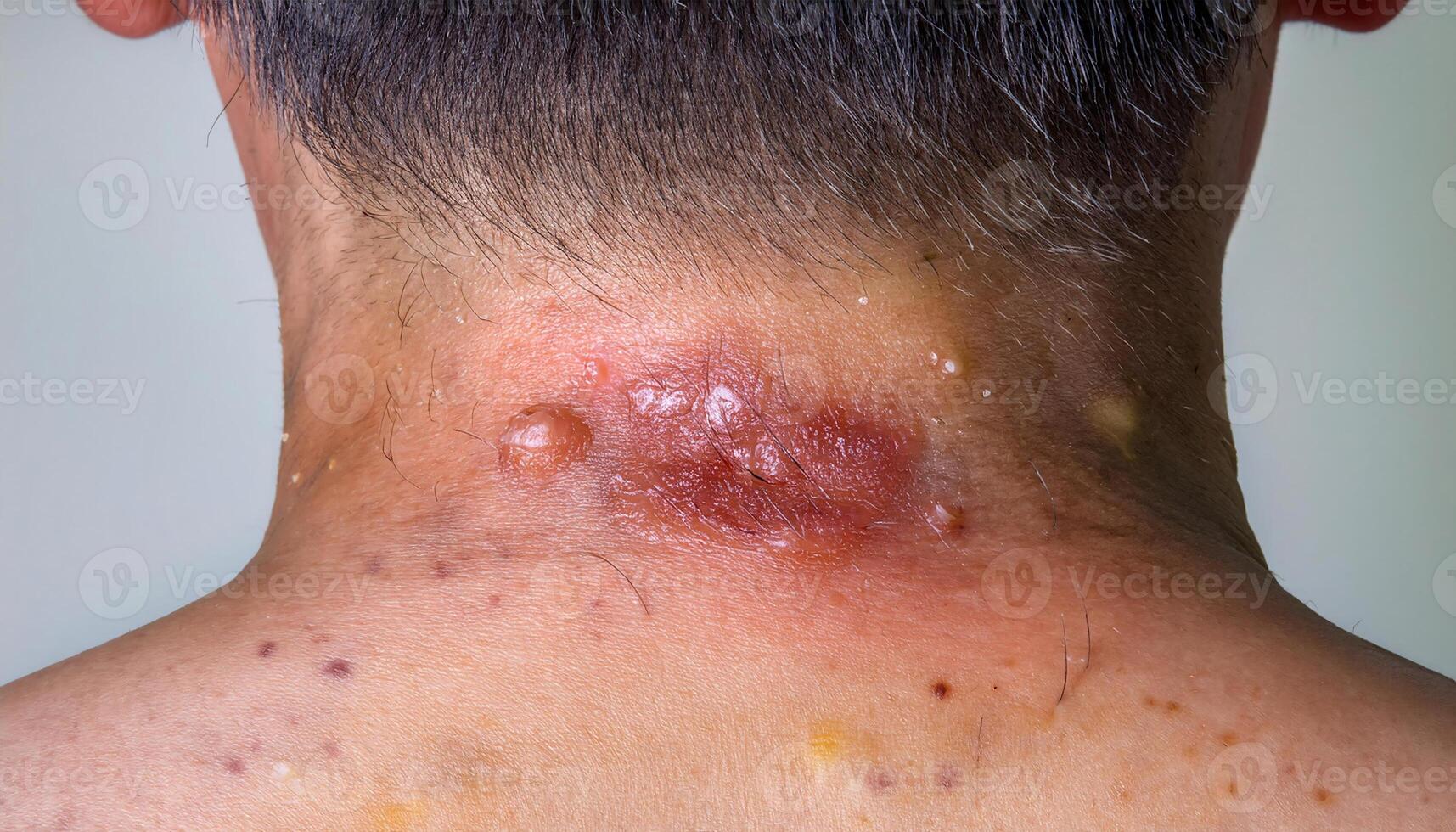 close-up of infected ringworm lesion on neck with raised red and inflamed border, fungal skin infection with pus-filled blisters photo
