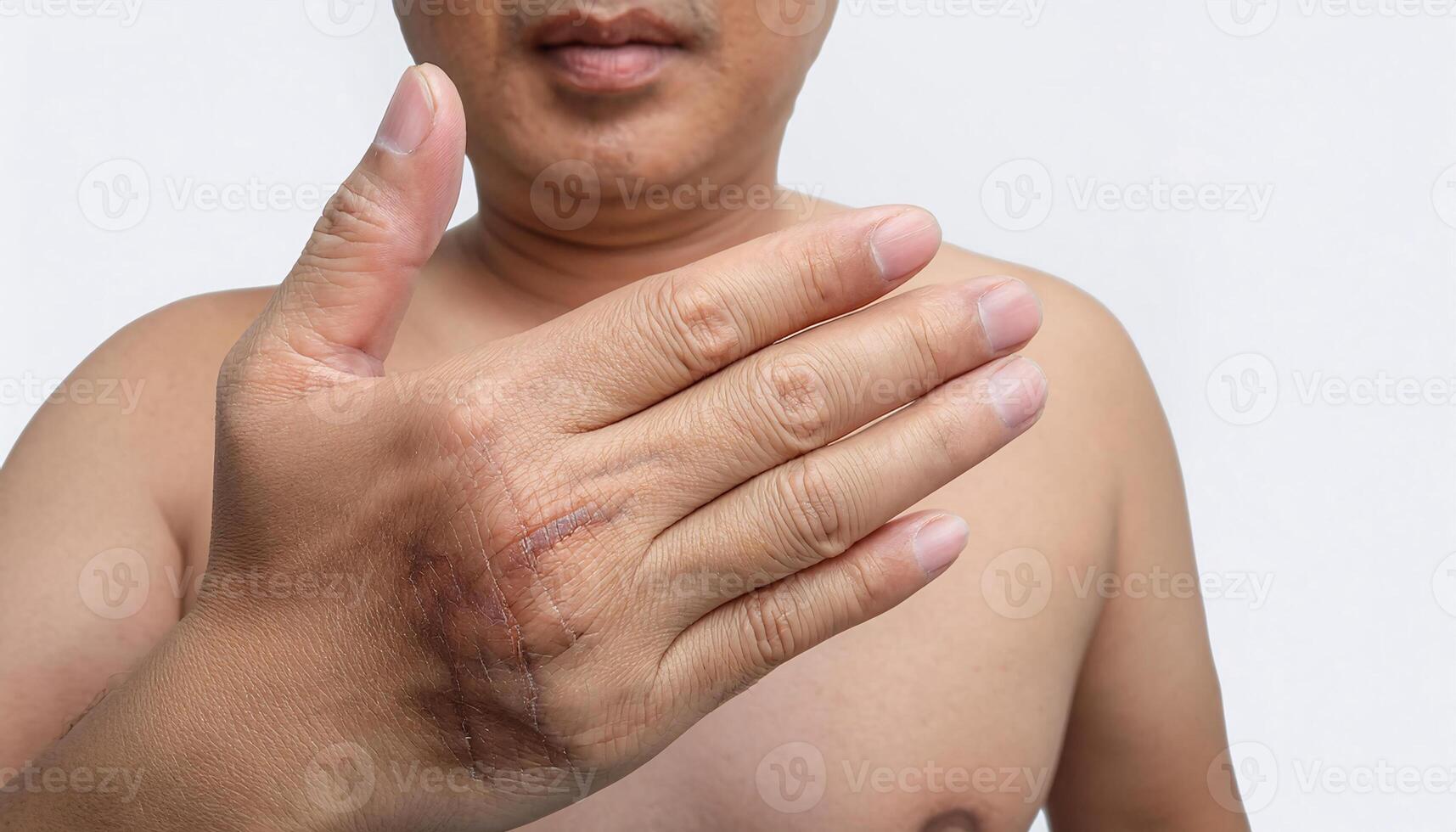 close-up of a hand with visible scar caused by a steam burn, showing detailed healing lines and skin texture in isolated white background photo