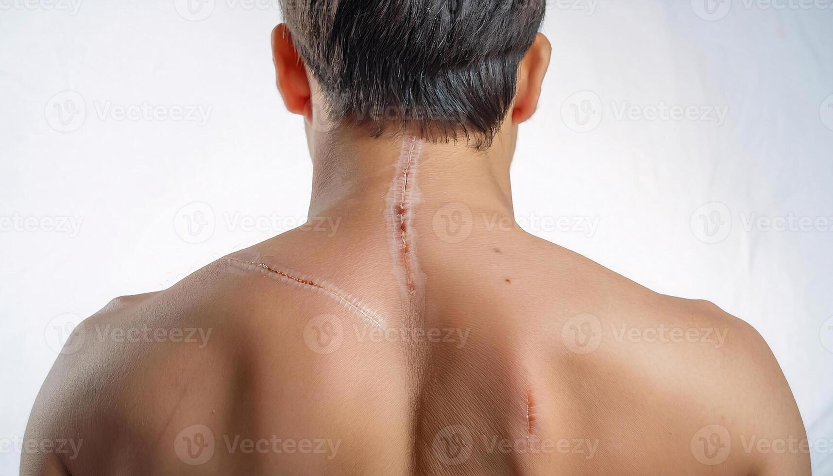 close-up of a scar on the back caused by an accidental scratch from a metal fence, showcasing healing process and visible skin details in isolated white background photo