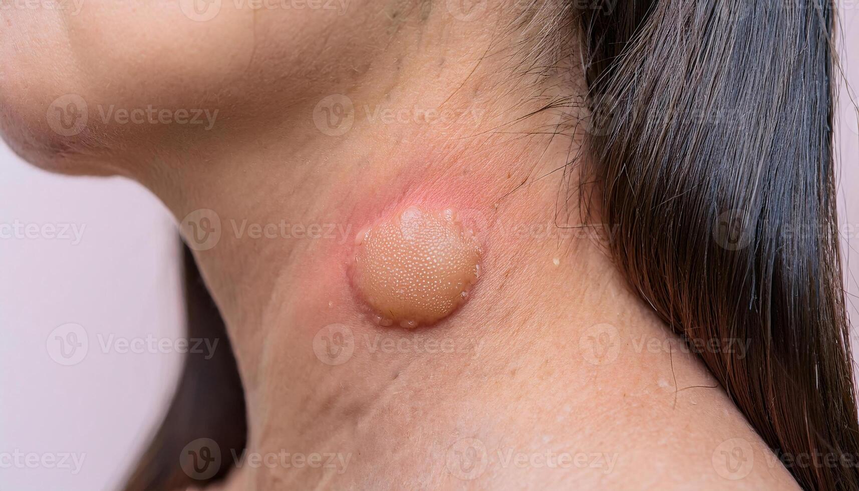 macro view of an inflamed neck boil with pus-filled center and red surrounding skin, close-up medical dermatology image photo