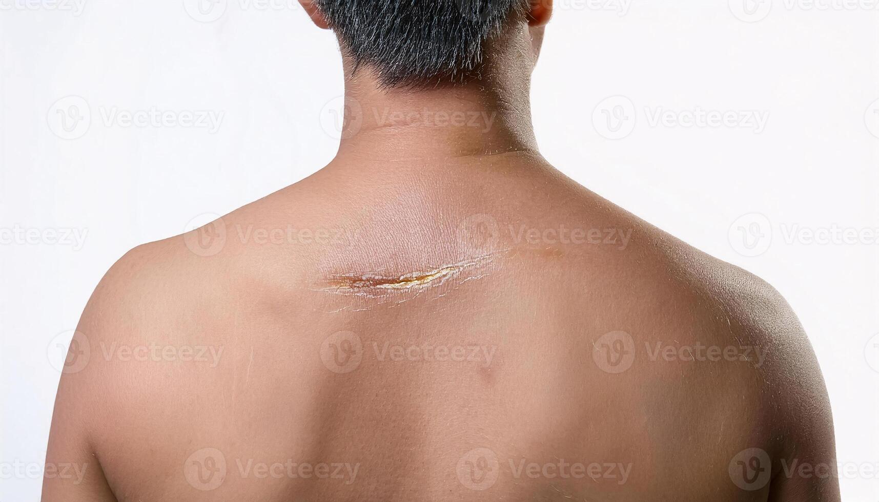 close-up of a deep scar on the upper back, showing detailed healing process and uneven texture in isolated white background photo