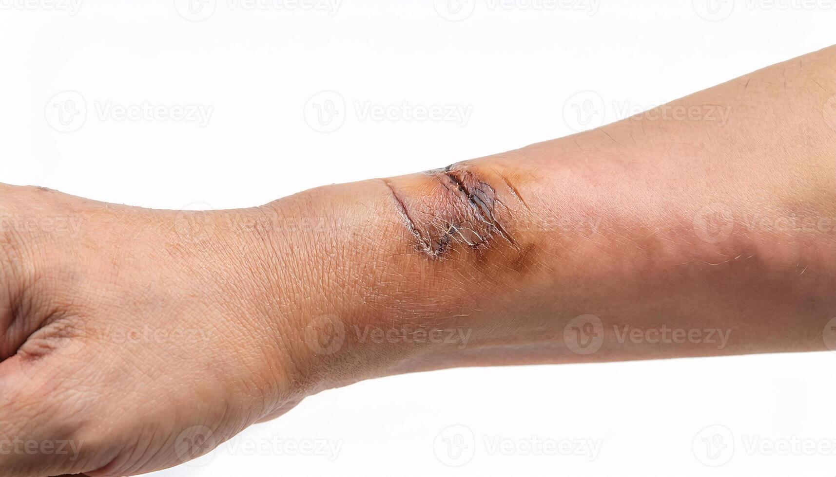 close-up of a scar from a grill burn on the wrist, featuring healing marks and wrinkled skin texture in isolated white background photo