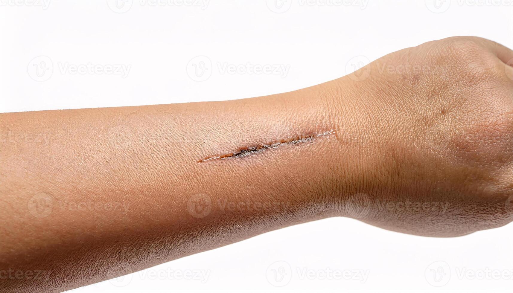 Macro view of an old scar from a cat scratch on the forearm, isolated white background photo