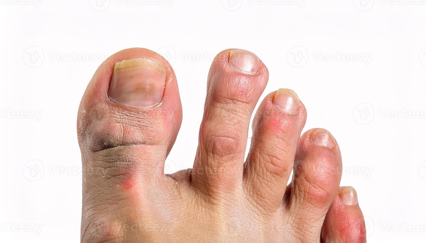 close-up of chilblains on toes with swollen, red, and itchy skin caused by cold exposure, isolated on white background photo