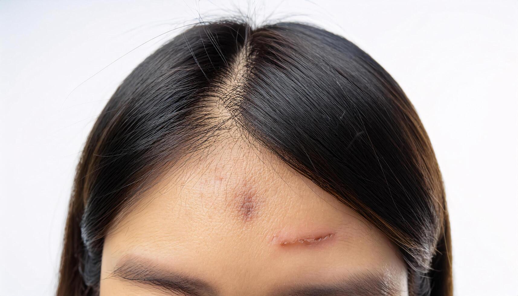 close-up of a scar on the forehead caused by a fall, featuring jagged edges and textured healing in isolated white background photo