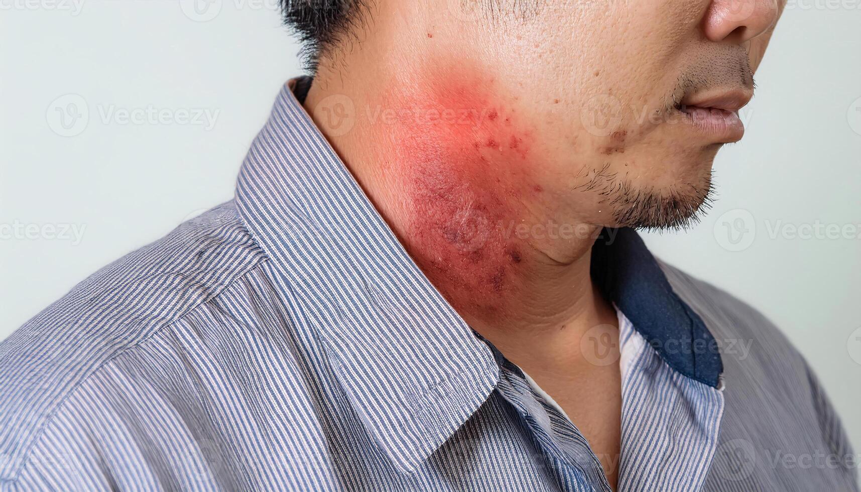 detailed shot of allergic contact dermatitis on the neck, showing inflamed red patches and irritation caused by skin reaction photo
